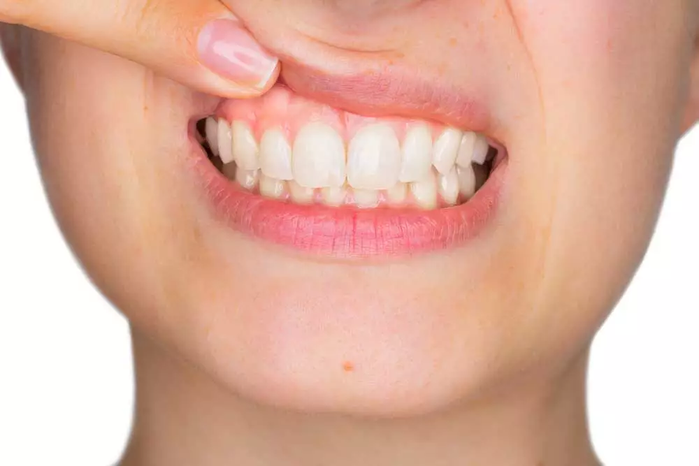 dental patient showing her gum disease infected gums