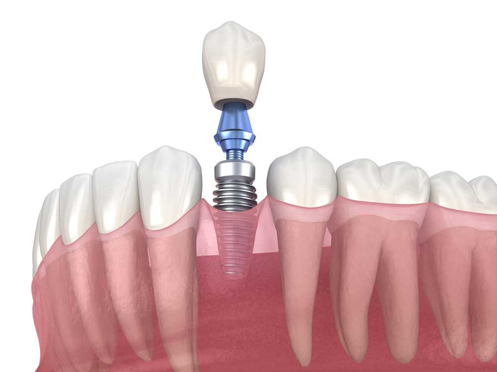 model of a dental crown being placed onto a titanium post