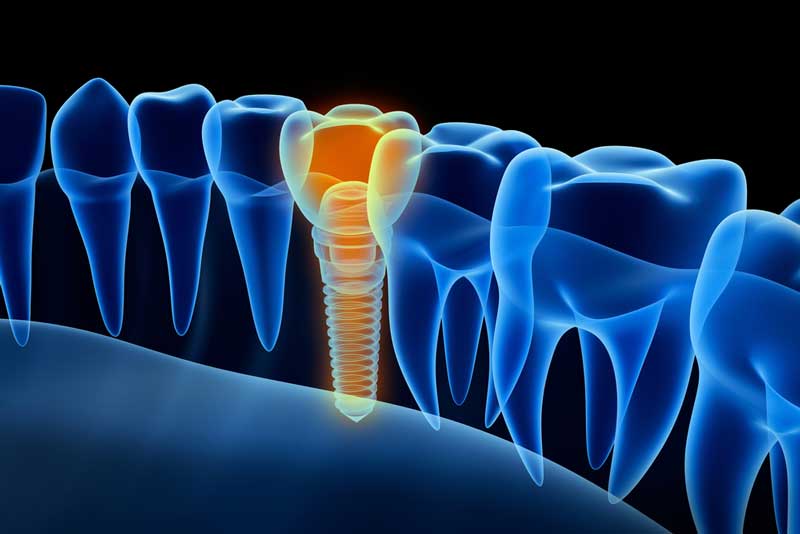 x-ray view of a placed dental implant