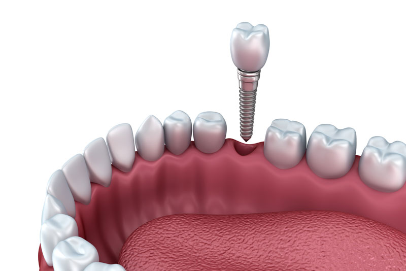Dental Implant Model 3