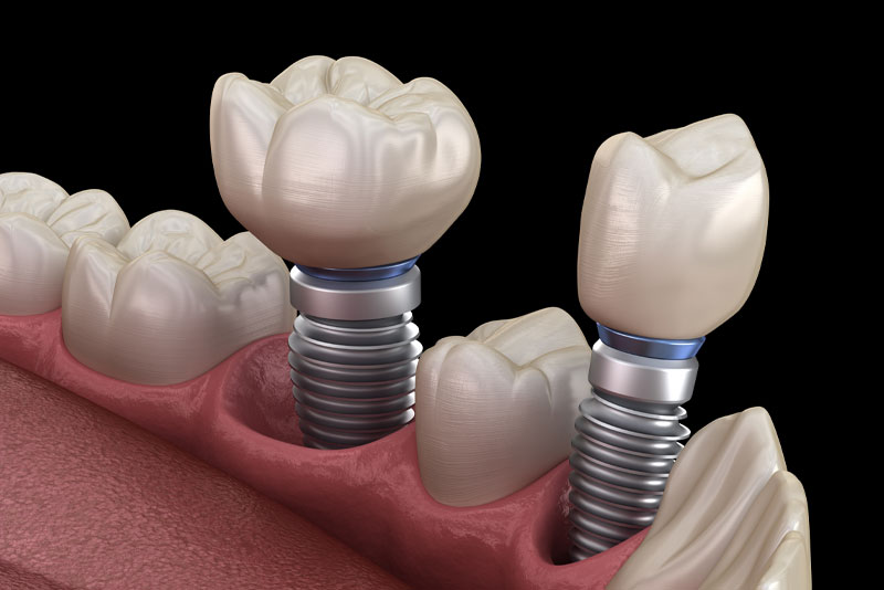 Two Single Dental Implants In The Gumline