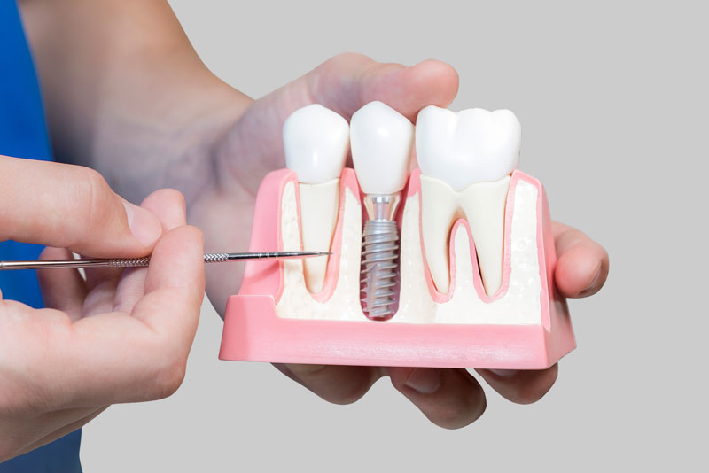 Dental Assistant Showing Off A Dental Implant In A Jawbone Cutaway Model in Greenwich, CT