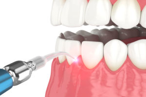 dentists in manhattan ny use lanap laser surgery to treat gum disease.