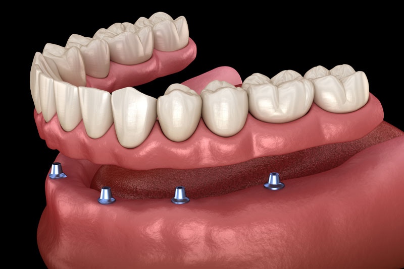 an image of an implant supported denture model showing four dental implants in the gums with a full mouth denture hovering over it.