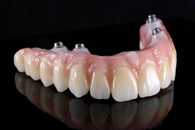 an image of a zirconia full mouth dental implant model. the 4 zirconia dental implant posts can be seen in the dental implant models gum line.