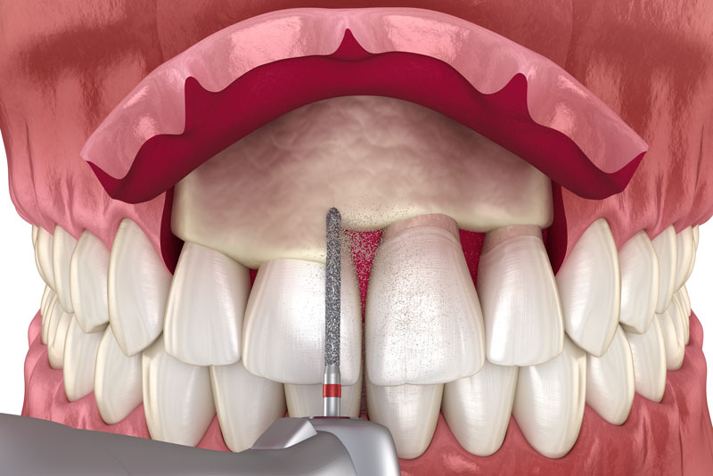 a crown lengthening procedure on a full mouth dental model.