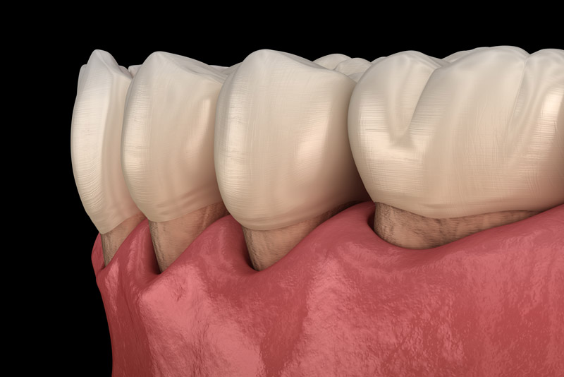 a graphic image of what gum recession looks like close up. more of the teeth are visibly exposed where the gum recession is occurring.