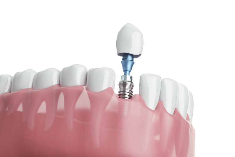 a digitial model of a single dental implant being placed in a lower arch.
