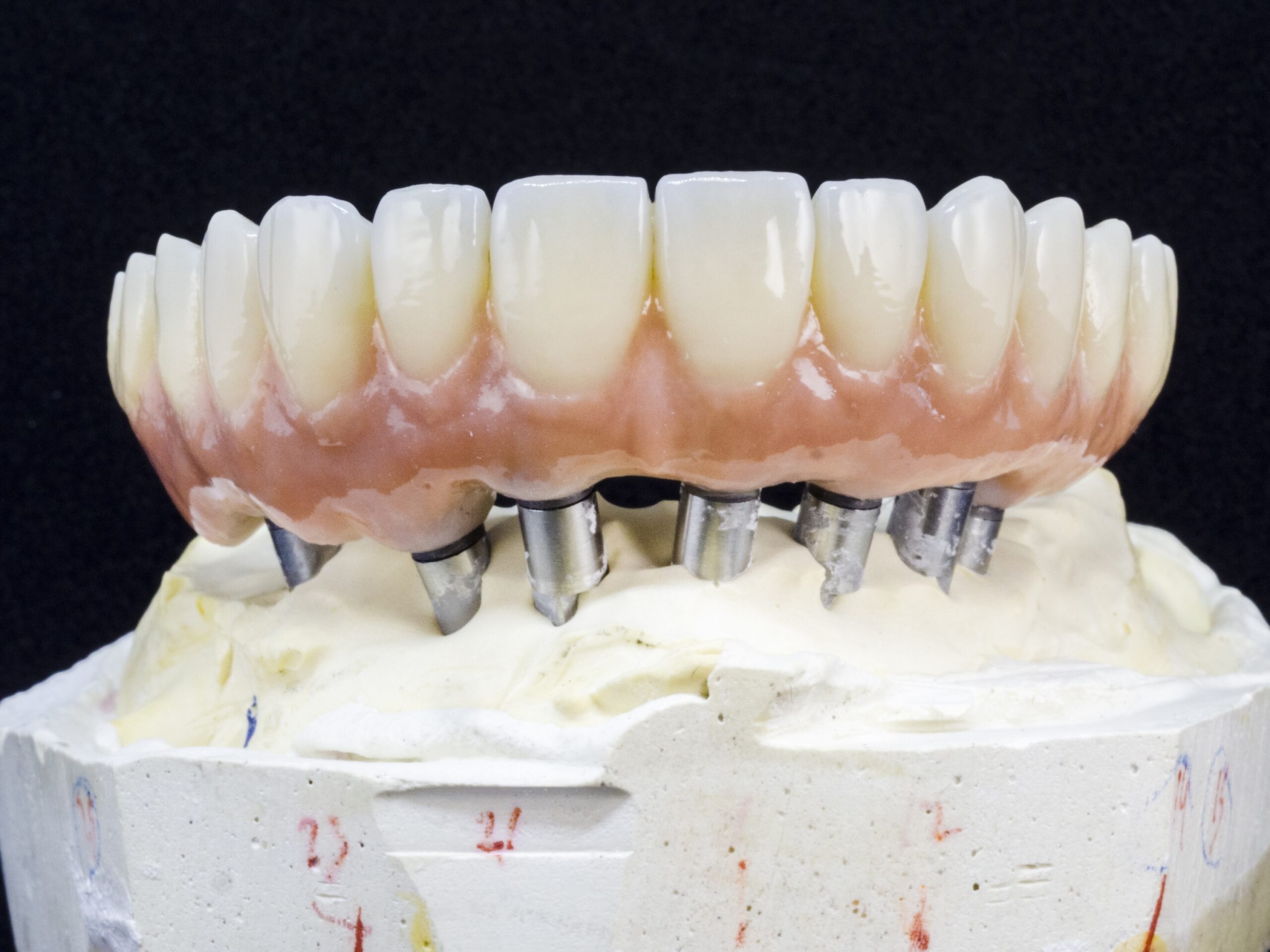 Implant supported denture model.