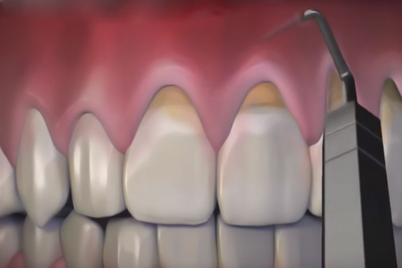 a graphic image of gums and teeth that have been affected by gum recession and are being treated with the Pinhole Surgical Technique.