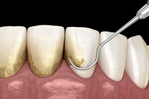 Close-up 3d image of a dental pick taking plaque off teeth.