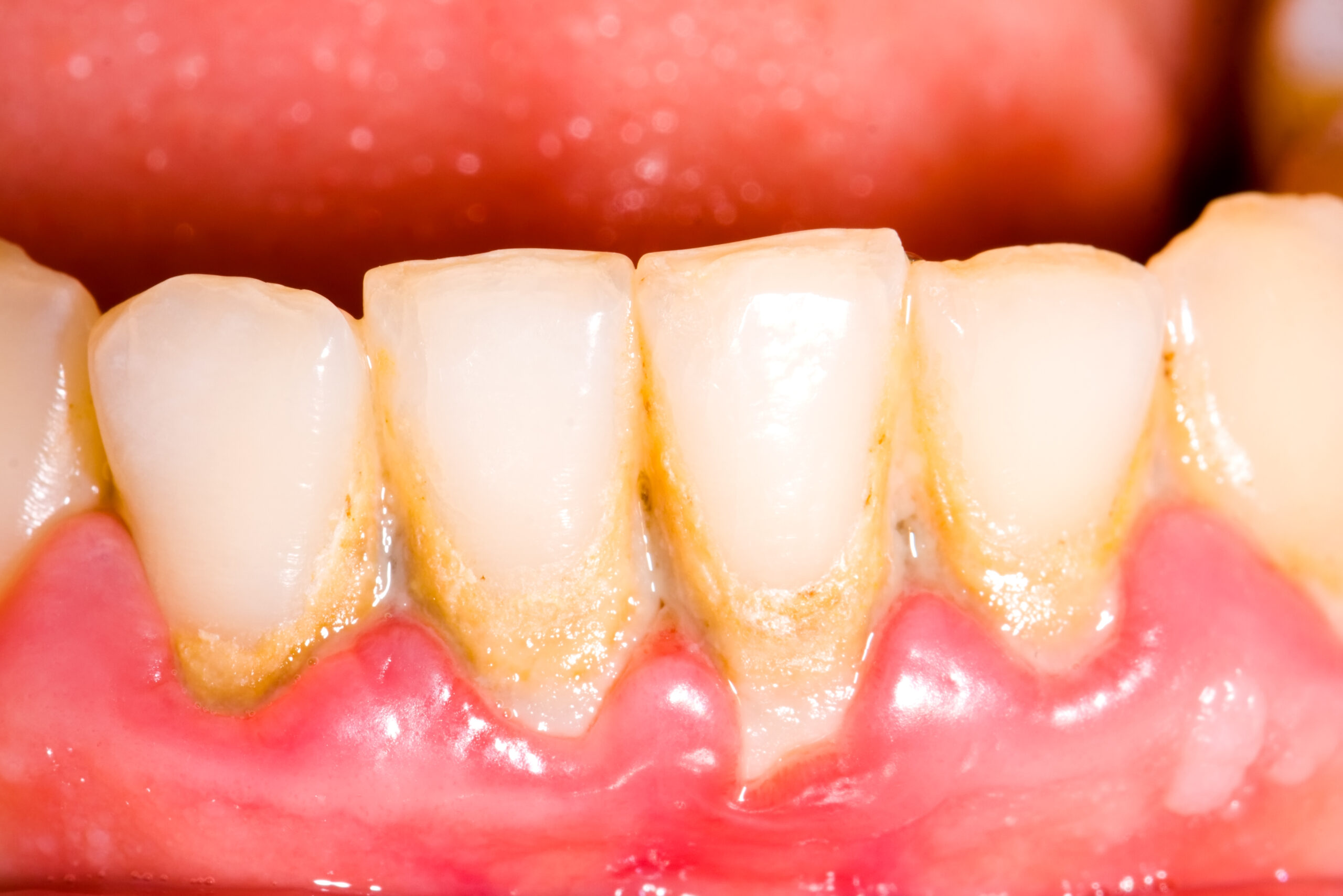 an image of a mouth with gum disease.