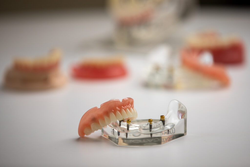 models of full mouth dental implant solutions.